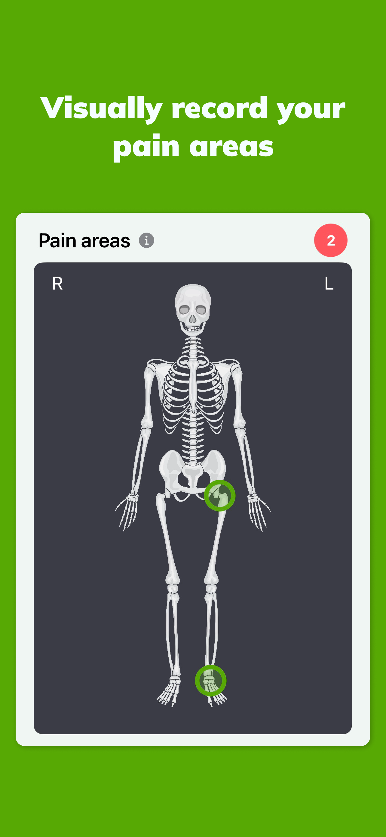 Rapha, Ankylosing Spondylitis