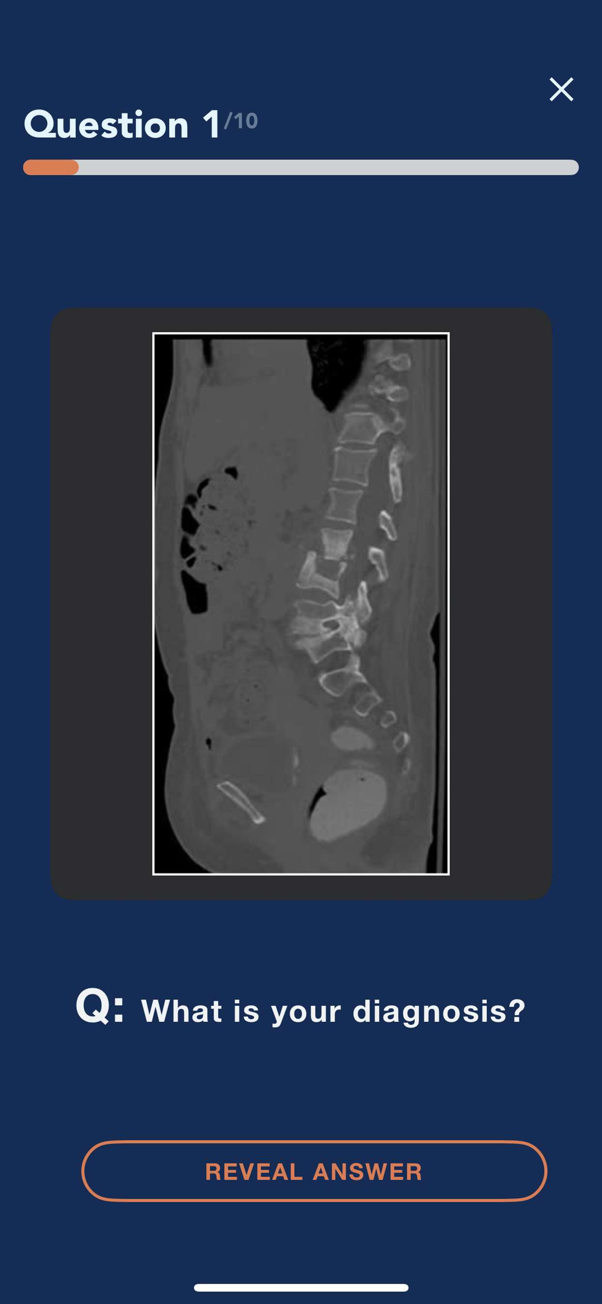 CTisus L-Spine Pathology