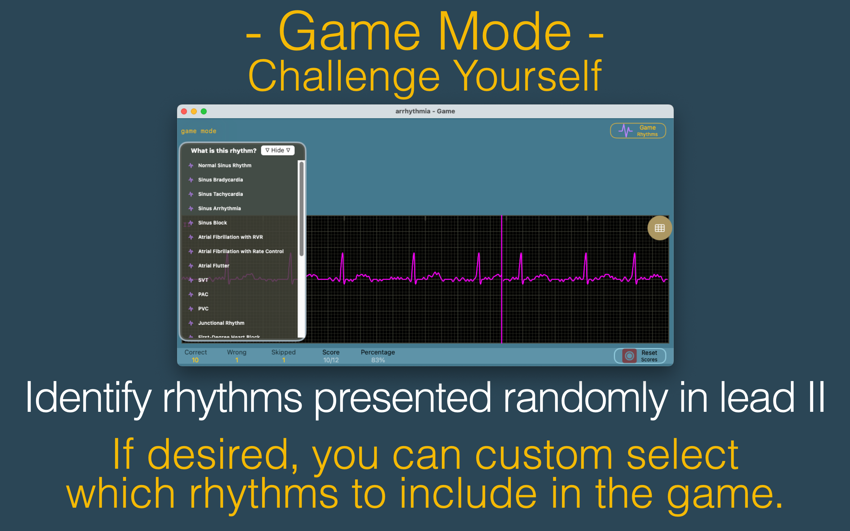 arrhythmia