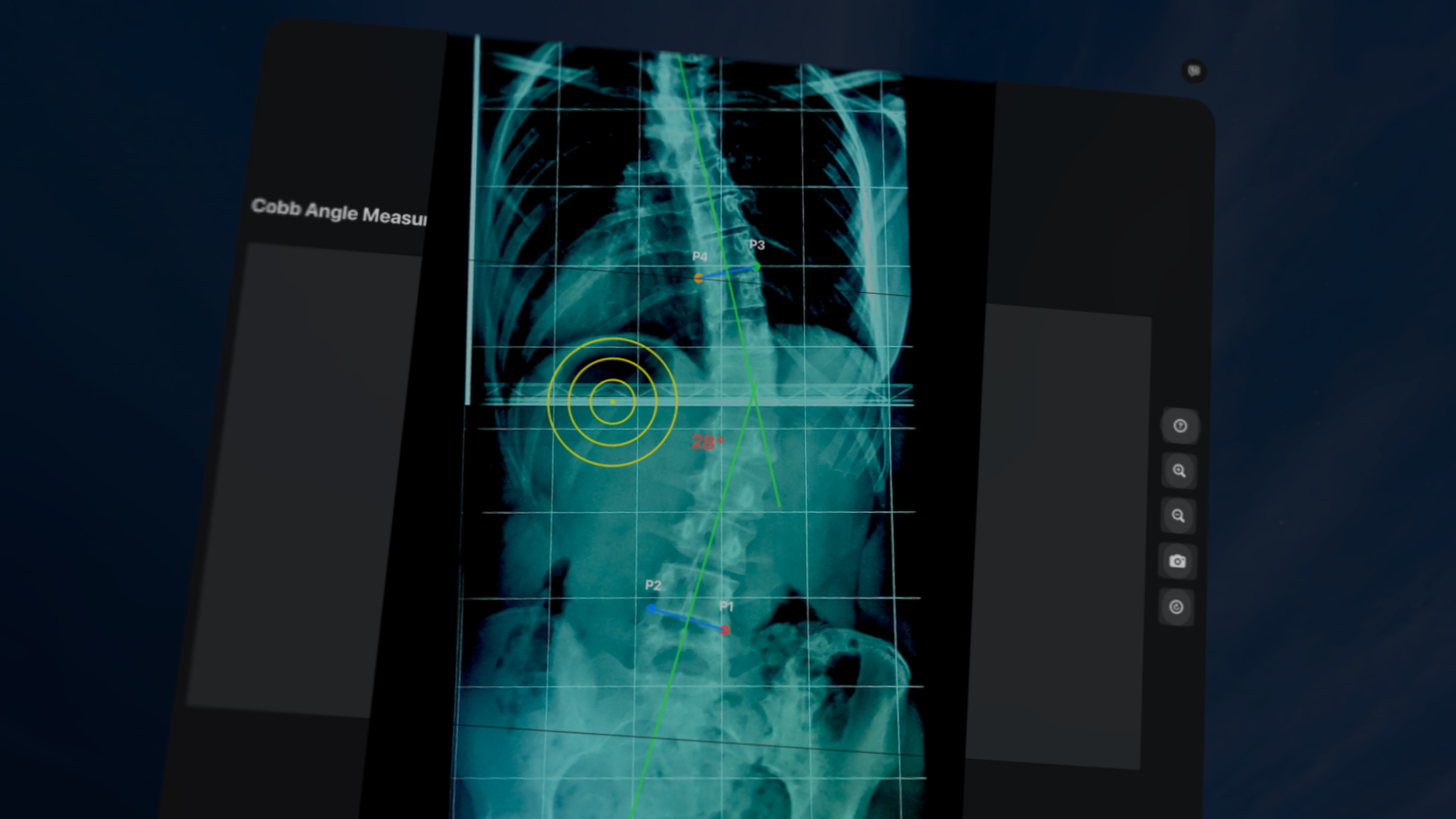 CobbAngleApp screenshot 17