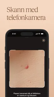 Oteria - Sjekk Føflekkene Dine iphone bilder 2