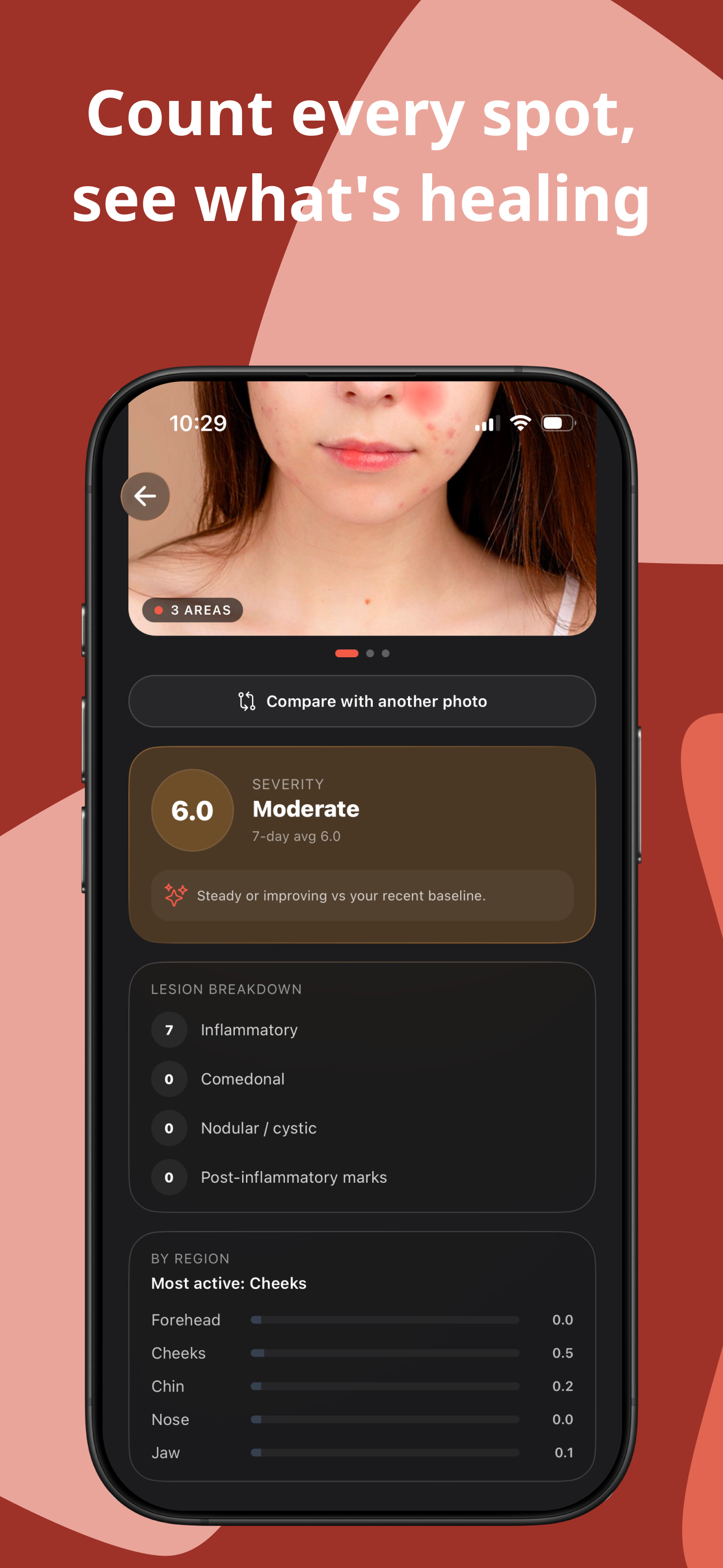 Acne Tracker: Skin Journal