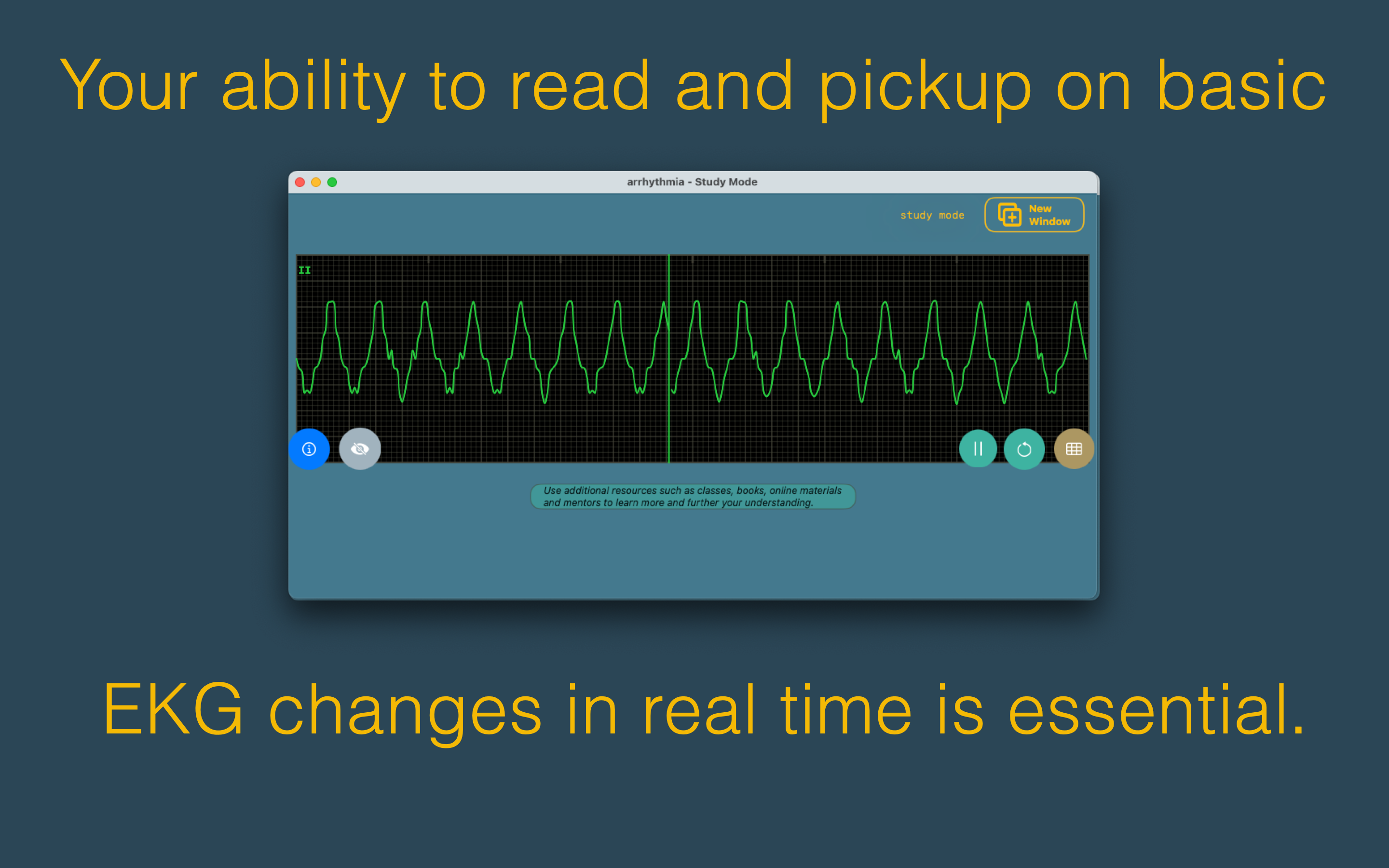 arrhythmia