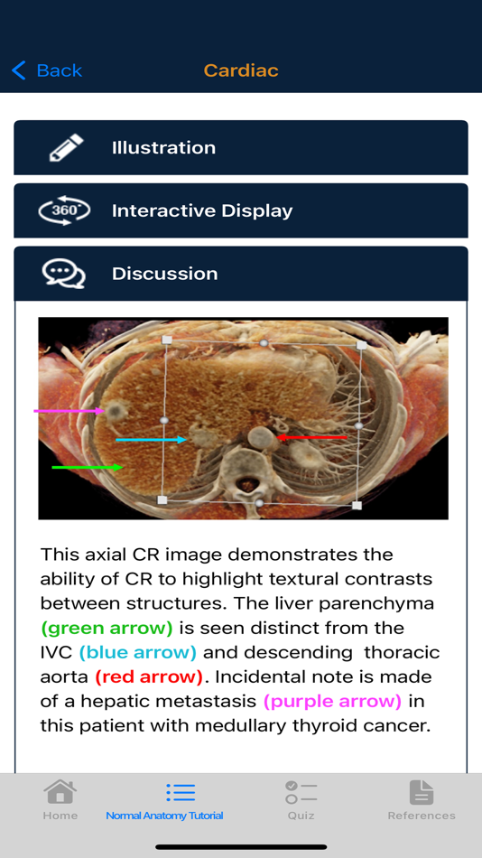 #5. CTisus Chest Atlas 3D CRT (iOS) Podle: Elliot Fishman