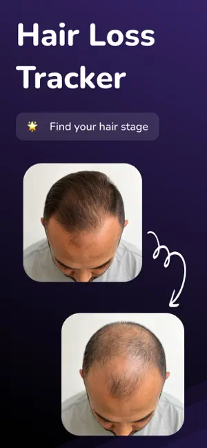 AI Hairloss Analysis - Tracker screenshot 1