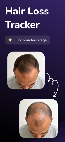 AI Hairloss Analysis - Tracker screenshot