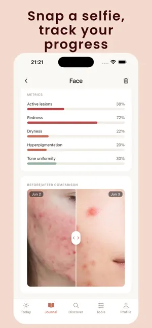 Klera: Acne & Isotretinoin screenshot 2