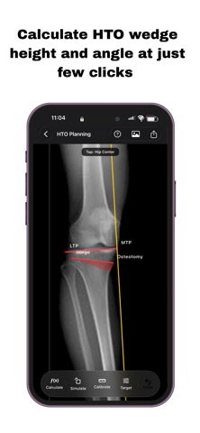 OsteoPlan screenshot