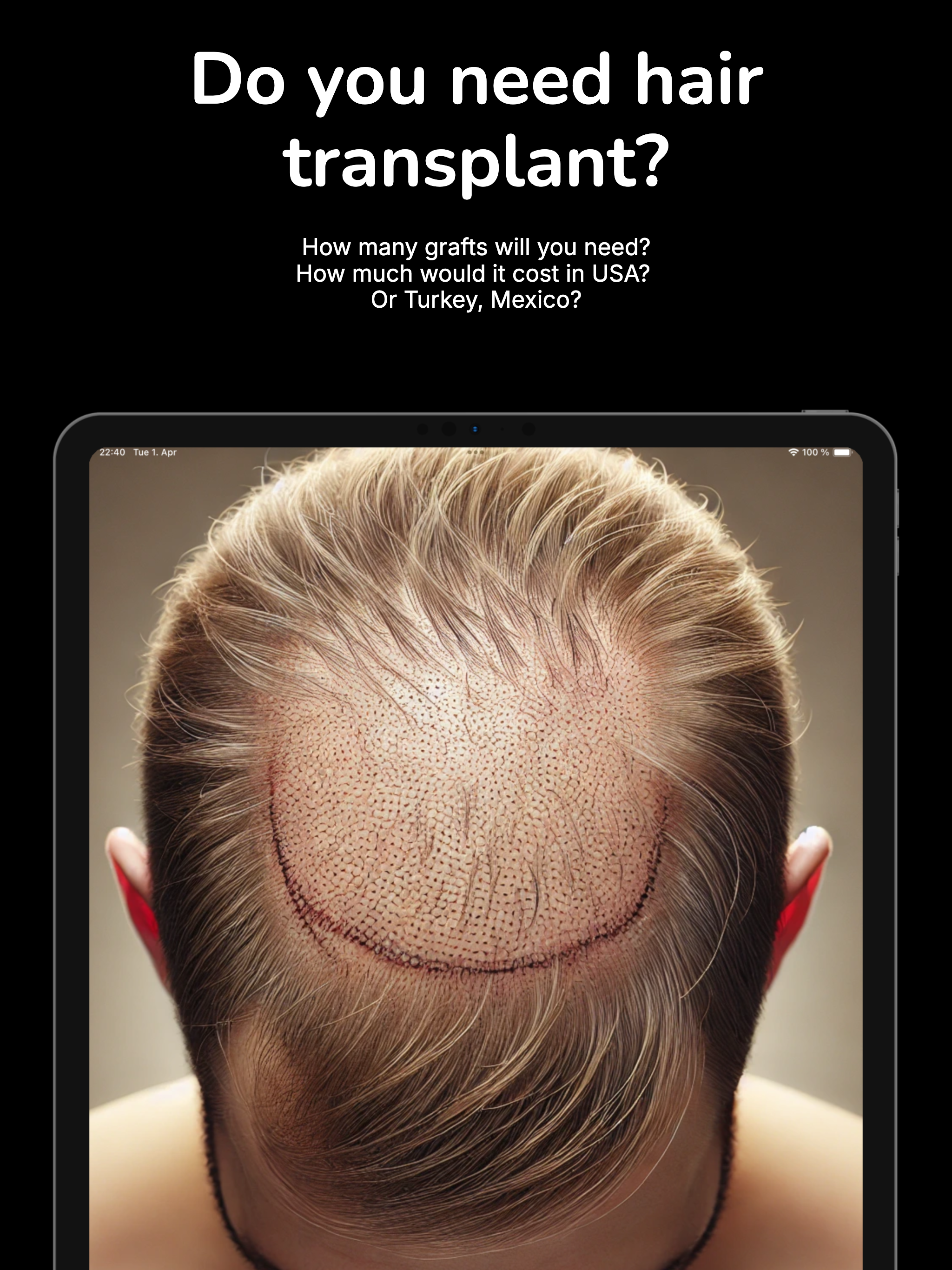 Hair Transplant AI Cost Expert