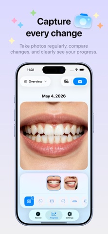 BraceTime: Aligner Tracker Screenshot 3 of 10