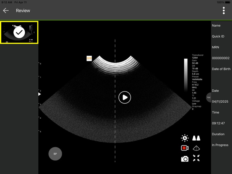 IBEX Wireless Ultrasound