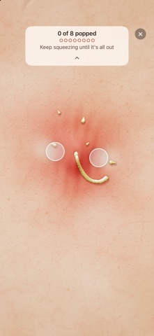 Pickless: Pimple & Skin ASMR screenshot 1