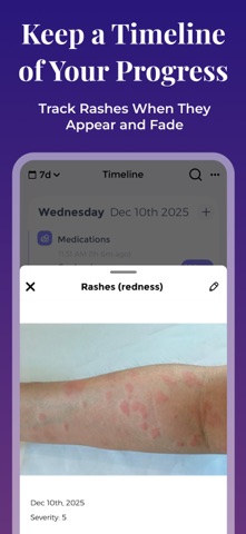 Lupus Tracker screenshot