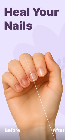 Unbite: Stop Nail Biting Screenshot 1 of 6
