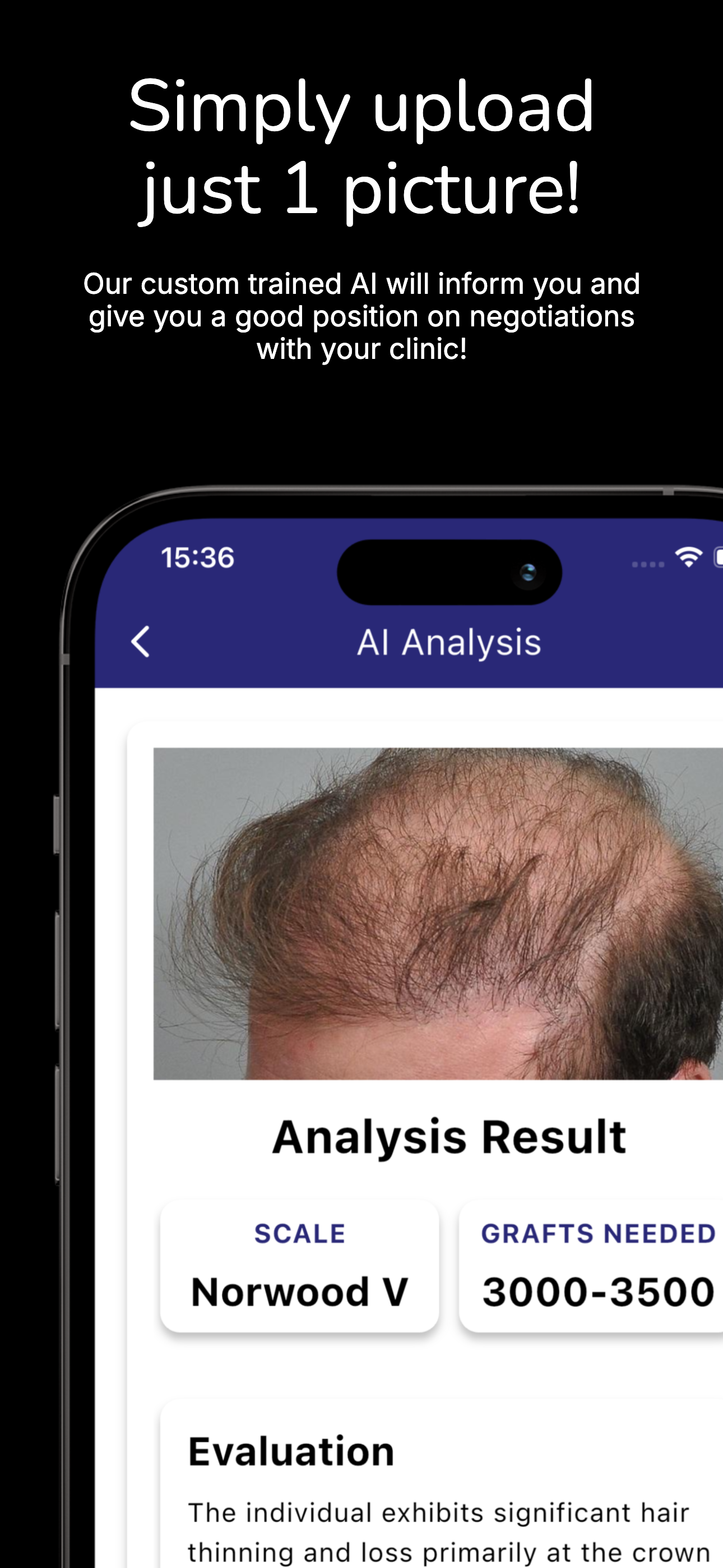 Hair Transplant AI Cost Expert