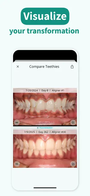 TrayMinder: Aligner Timer screenshot 2