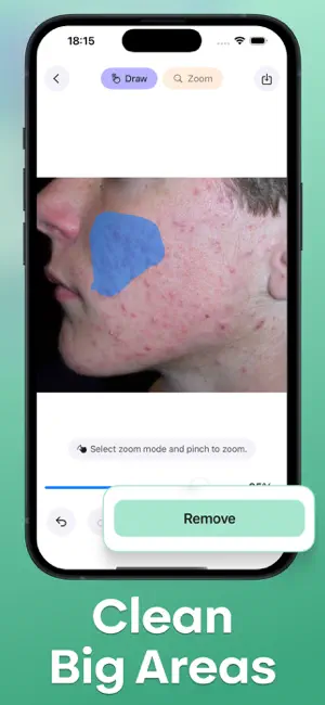 Acne Remover - Pimple Eraser screenshot 4