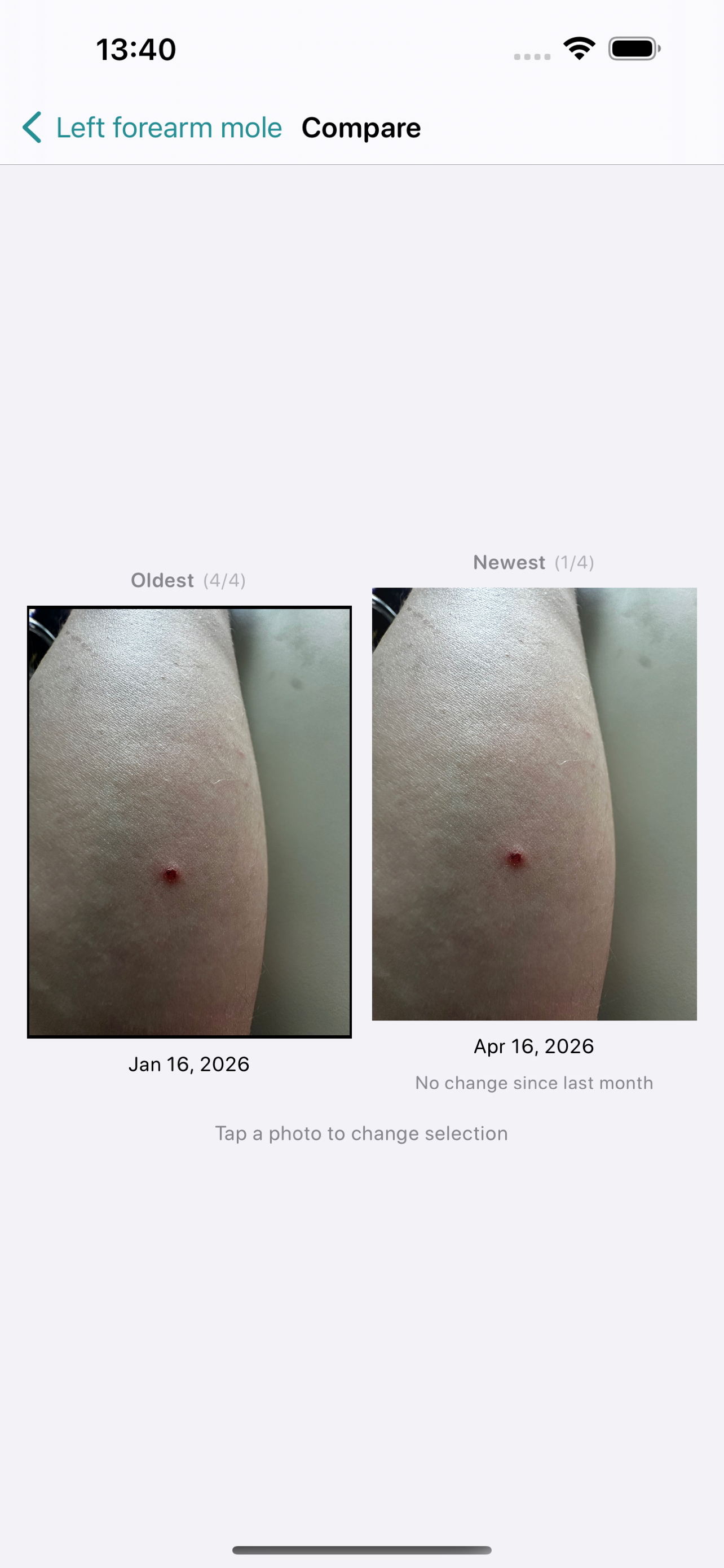 Mole Tracker: Skin Photo Diary screenshot 4