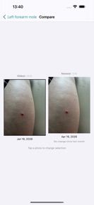 Mole Tracker: Skin Photo Diary screenshot