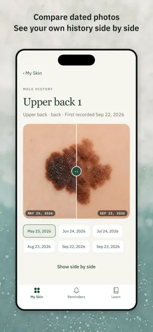 Holey Mole: Skin Tracker screenshot 2