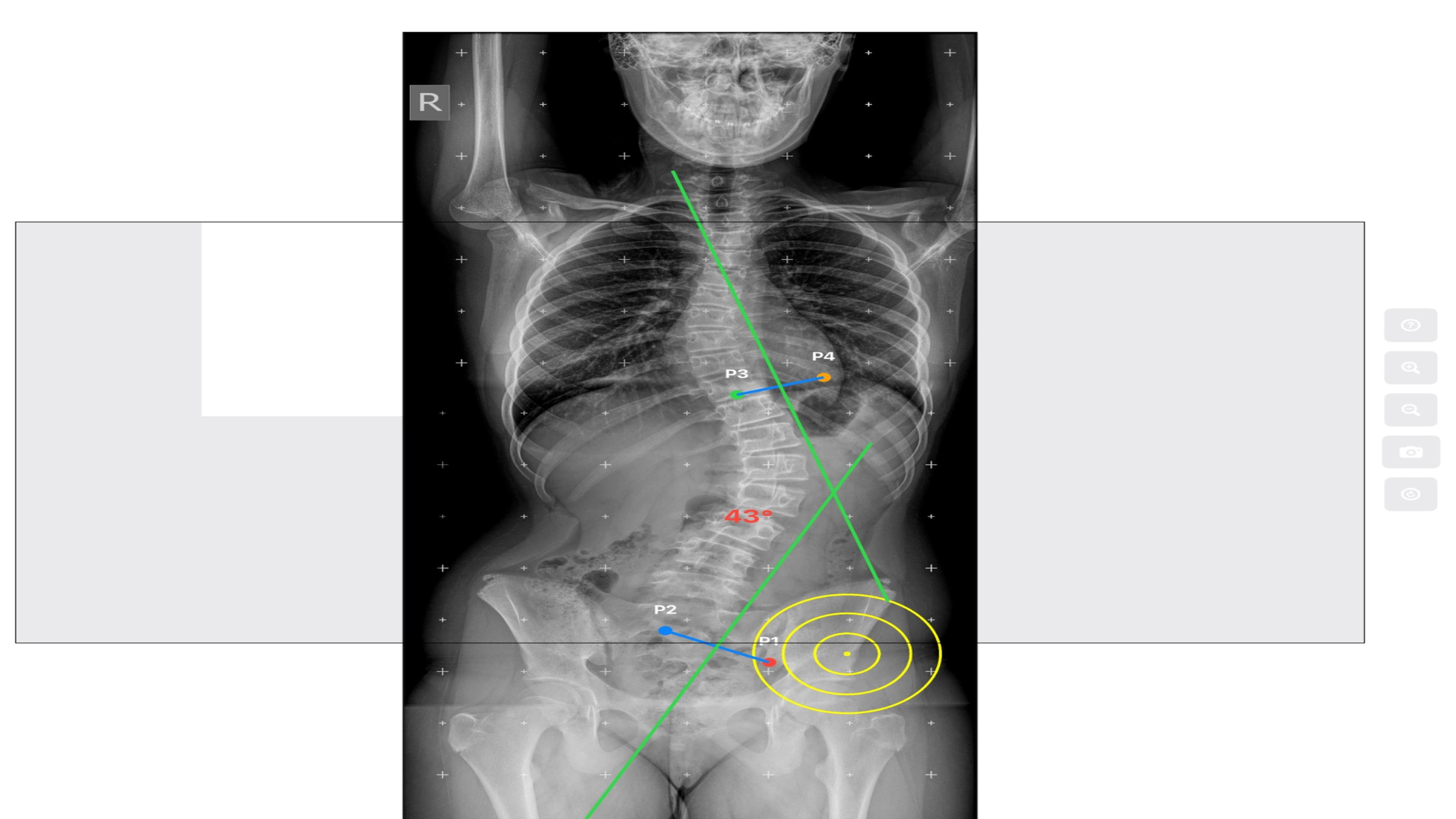 CobbAngleApp screenshot 23
