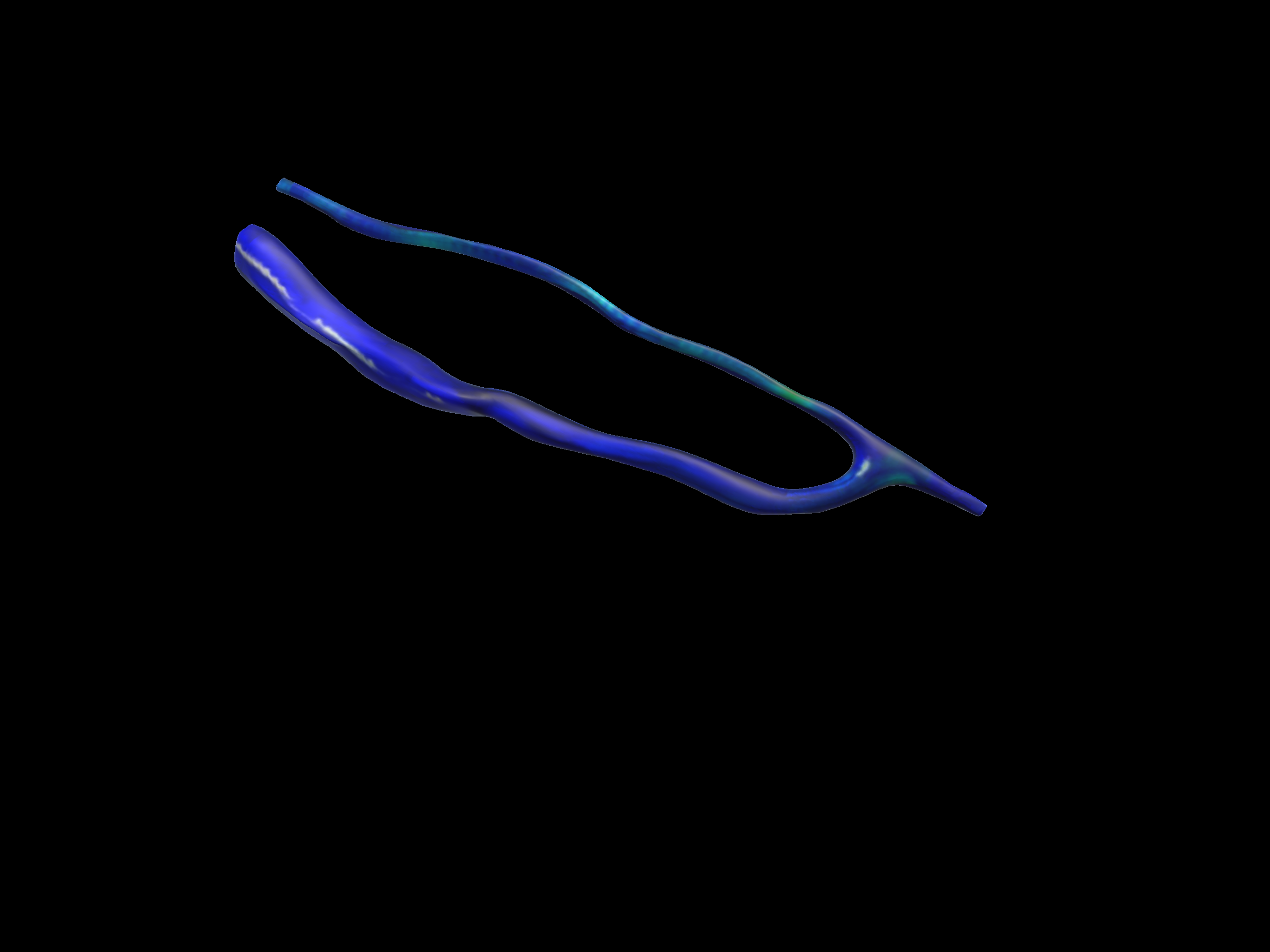 AVF Fistula