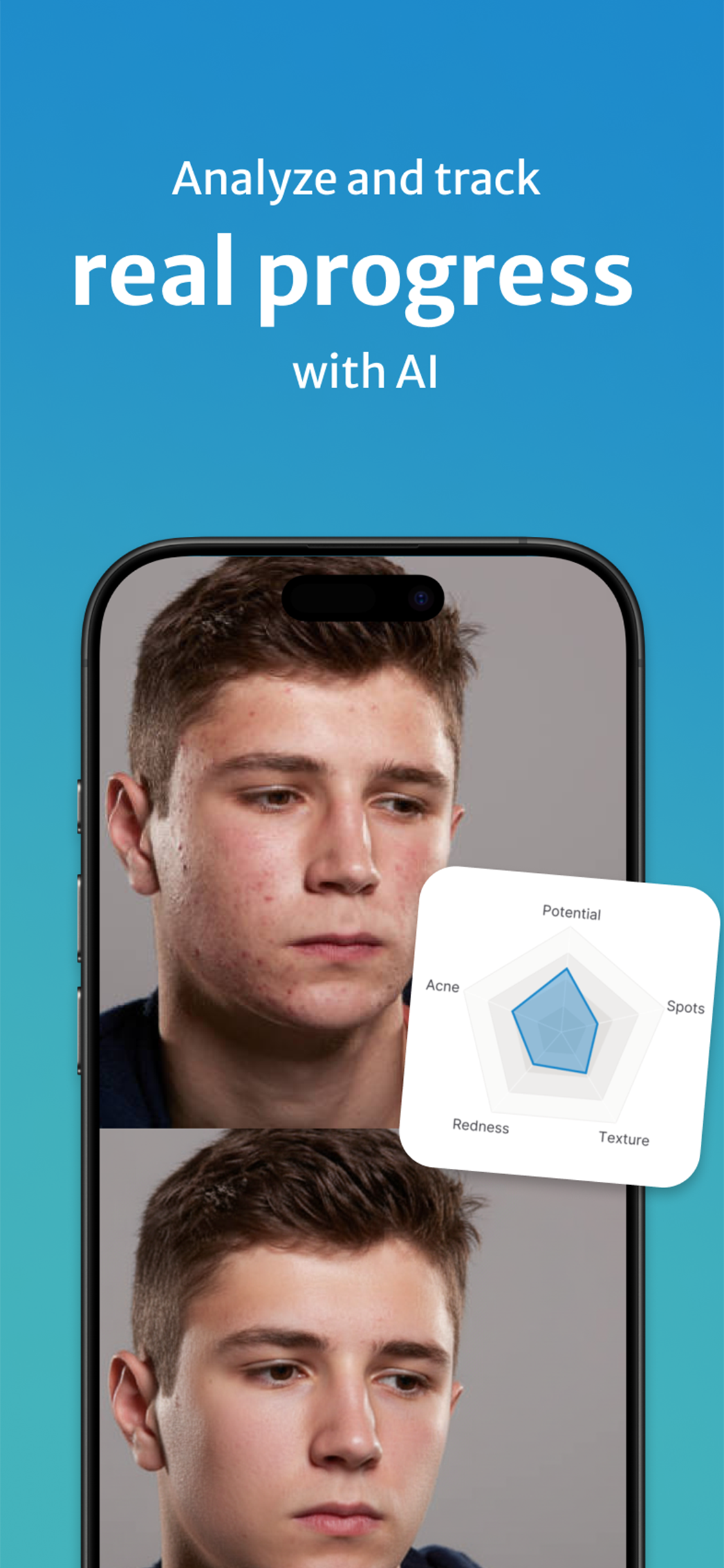 Acne Snap: Clear your skin