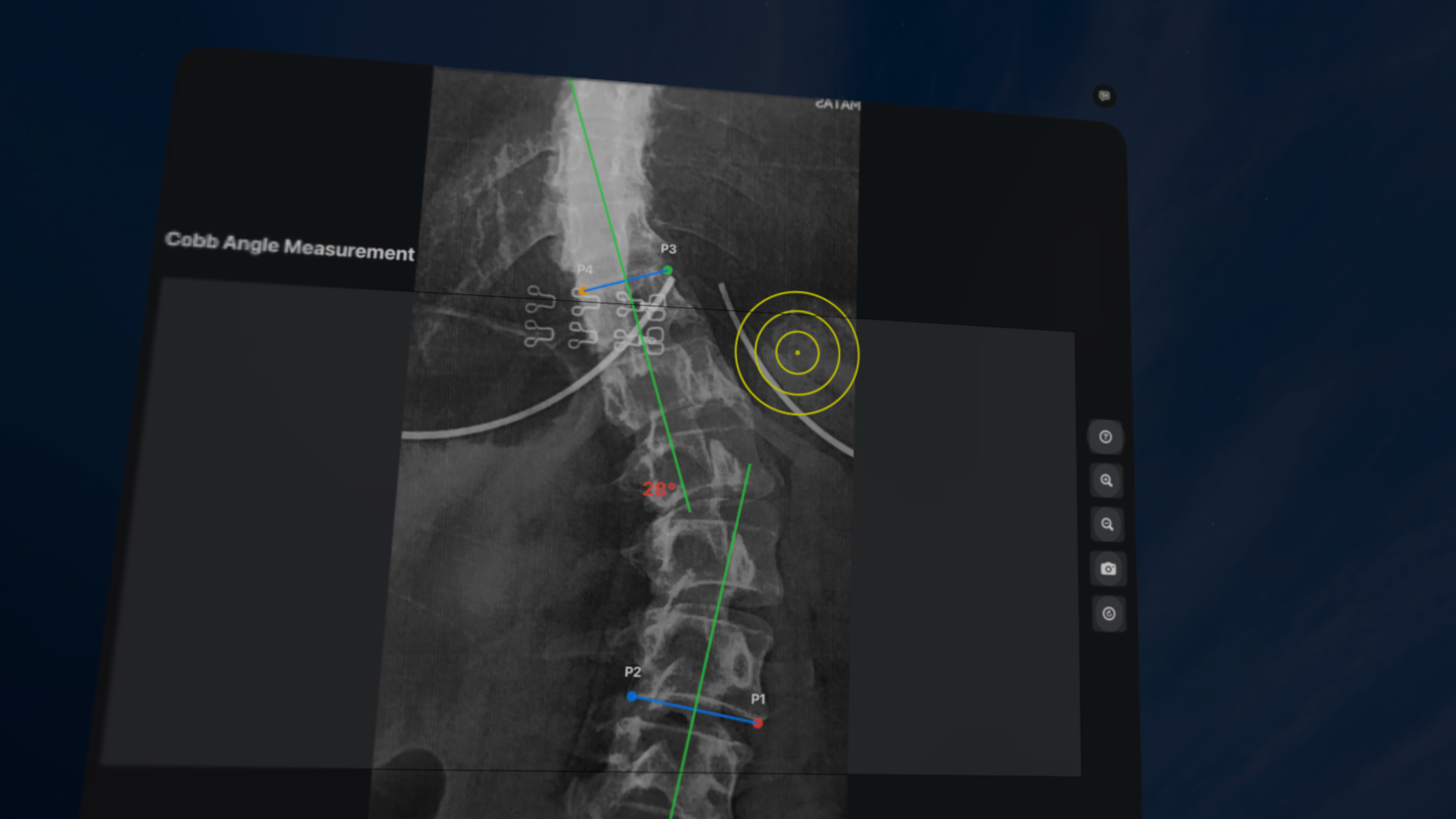 CobbAngleApp screenshot 22