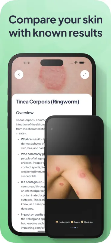 Rash ID: Skin Rash Identifier screenshot 6 of 7