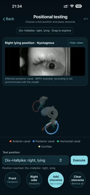 BPPV Simulator screenshot 2
