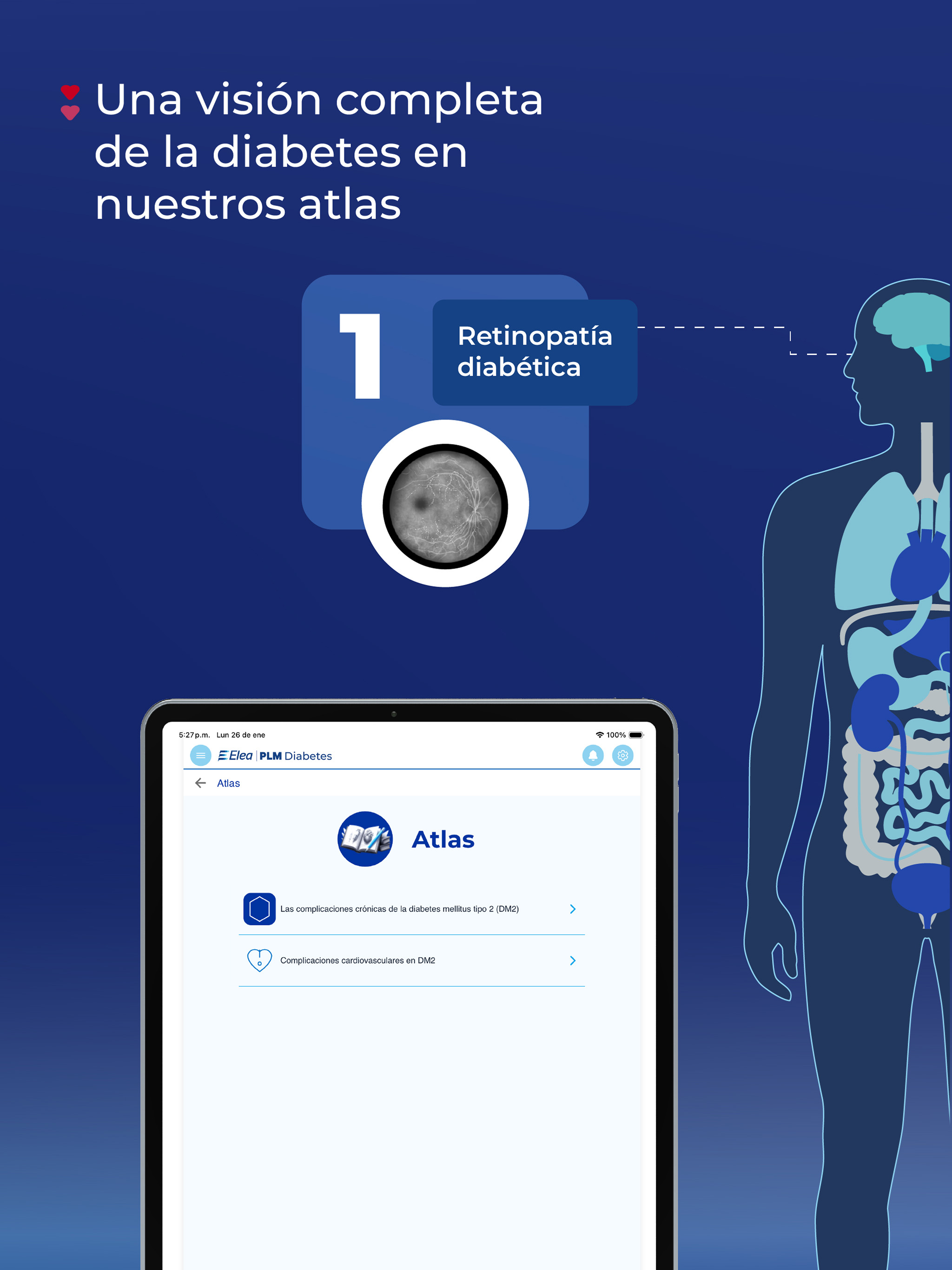 PLM Diabetes Ecuador