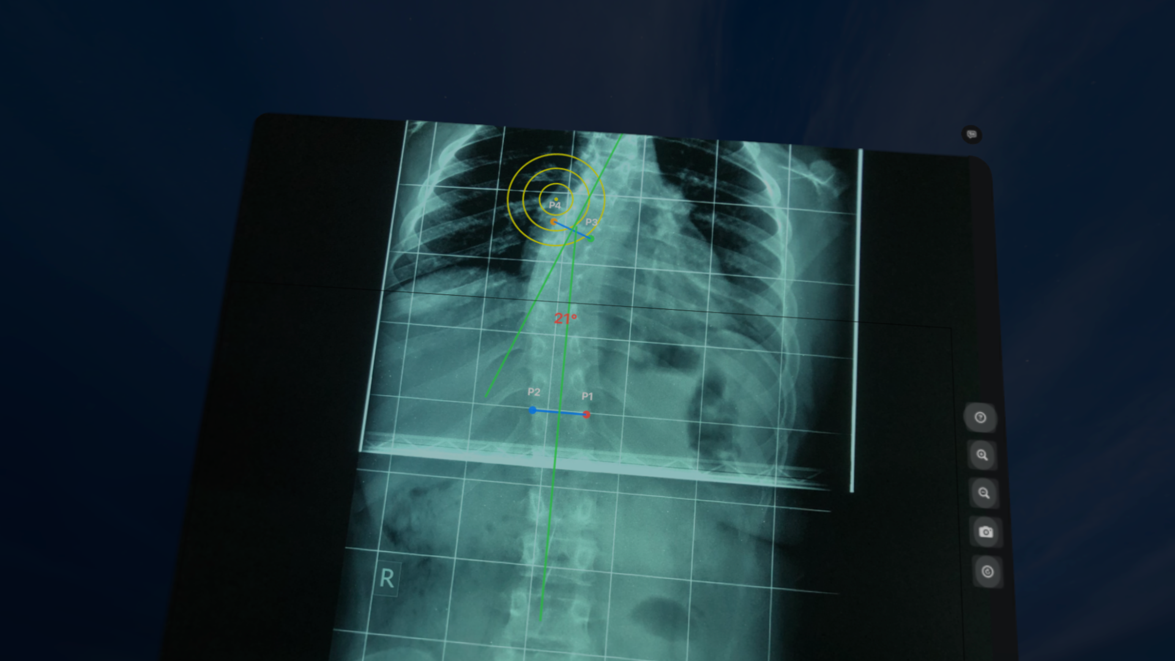 CobbAngleApp screenshot 19