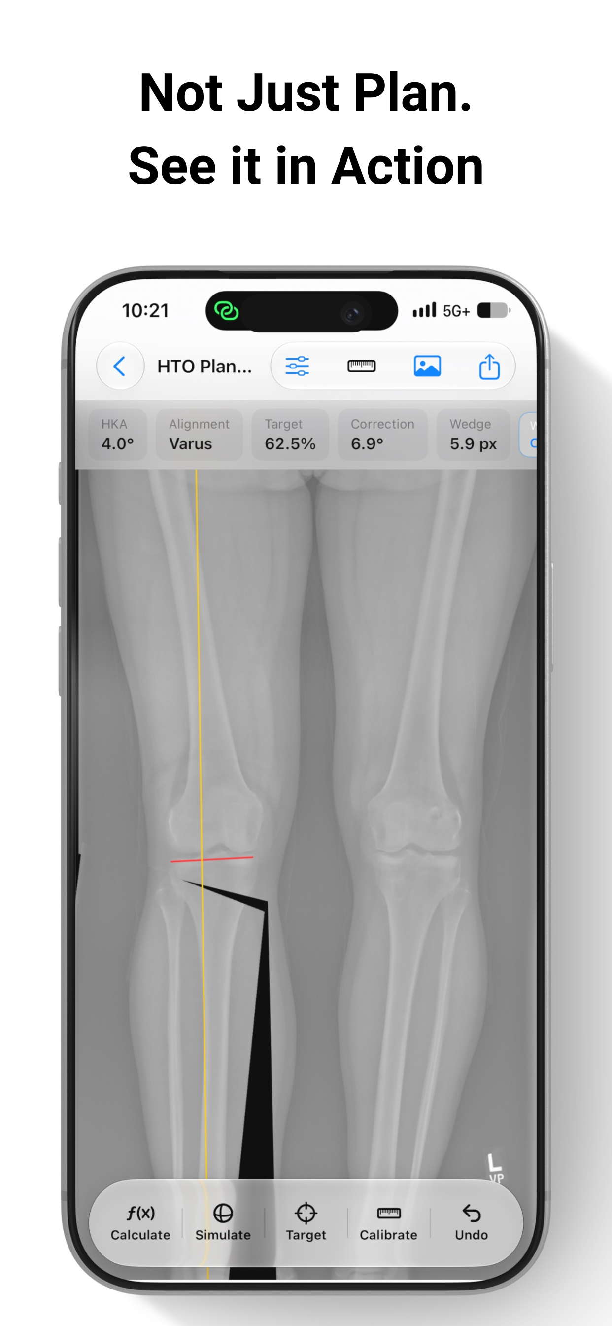 OsteoPlan screenshot 3