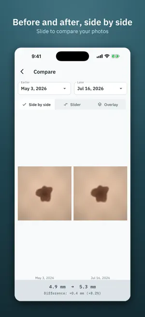 Dermory: Mole & Skin Tracker screenshot 4