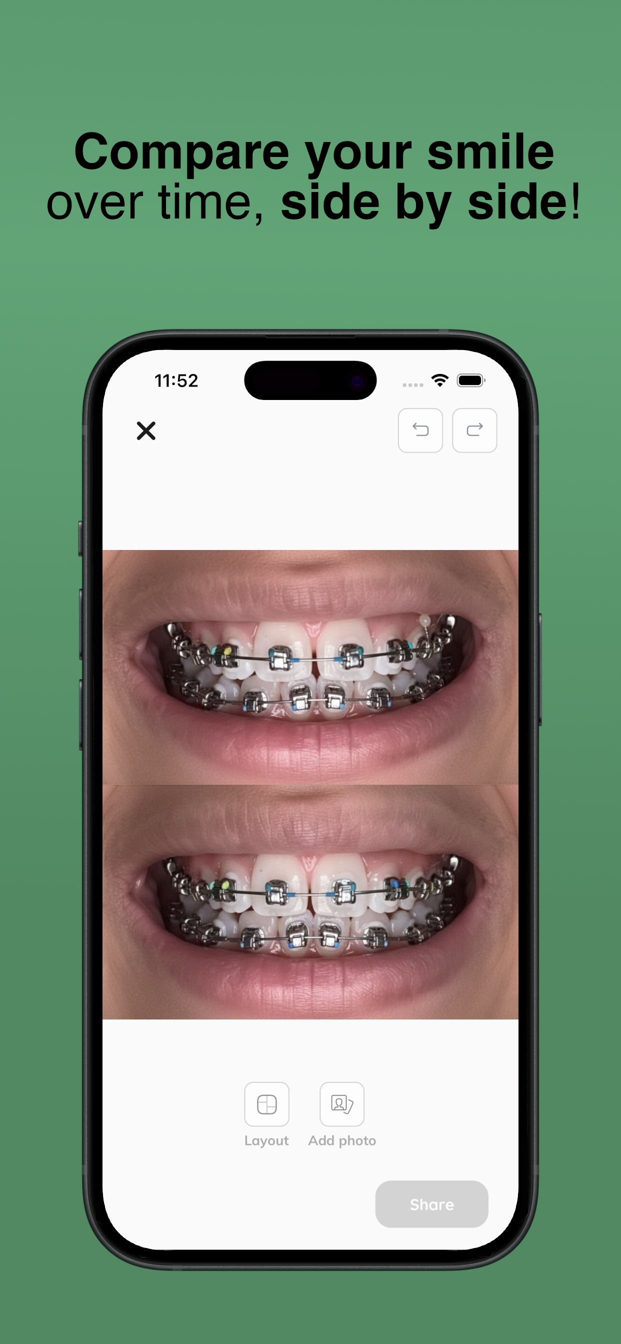 My Braces Tracker
