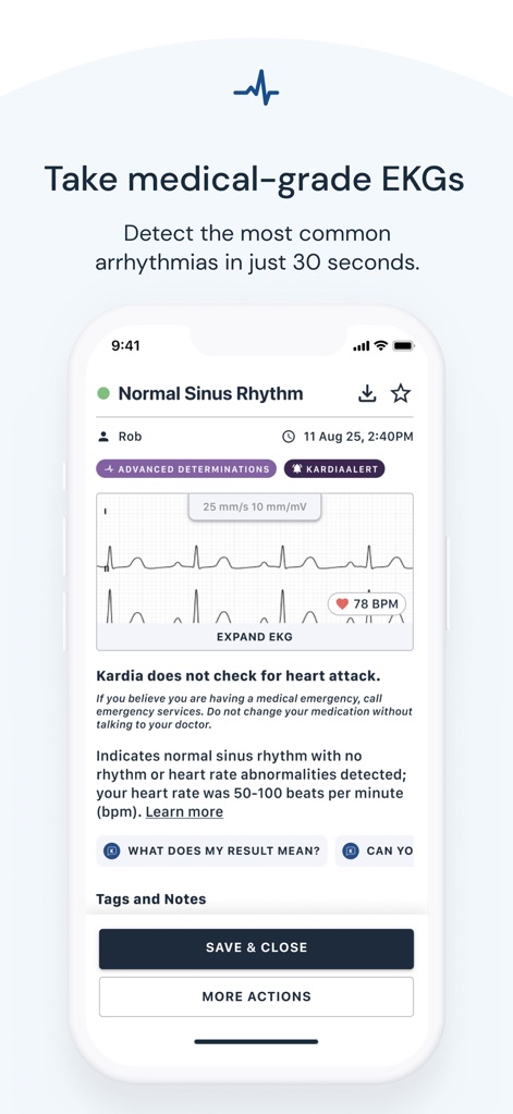 Kardia - The app visualizes detailed EKG waveforms and provides instant analysis, clearly displaying a 'Normal Sinus Rhythm' result and the current heart rate in BPM.