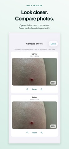 Mole Tracker: Skin Check Diary Screenshot 1 of 10