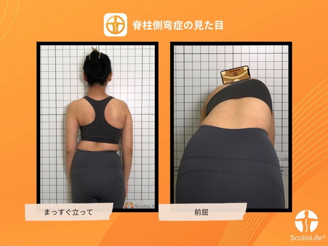 側弯症テストメーター側弯症測定ツール0-30°測定評価背中と脊椎