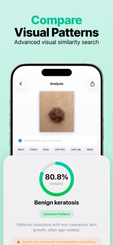 AI Mole Analyzer Screenshot 2 of 6