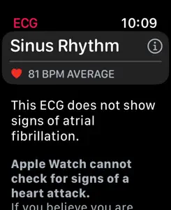 ECG screenshot #3 for Apple Watch