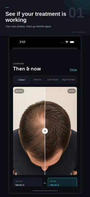 HairAgain: Hair Loss Tracker screenshot 1