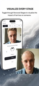 Hair Loss Tracker - BaldingAI screenshot