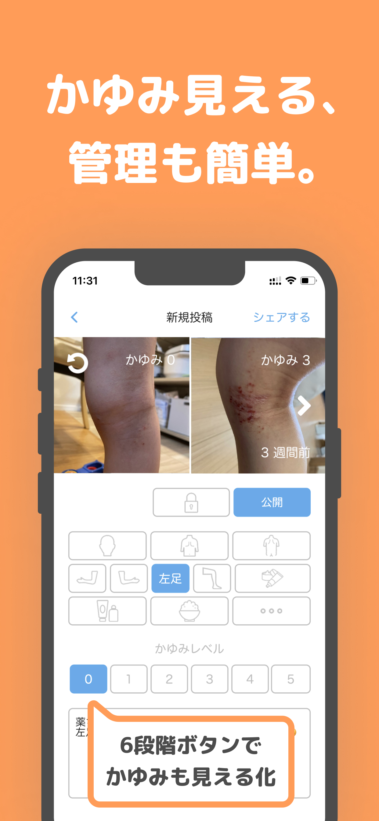 アトピー見える化アプリ-アトピヨ