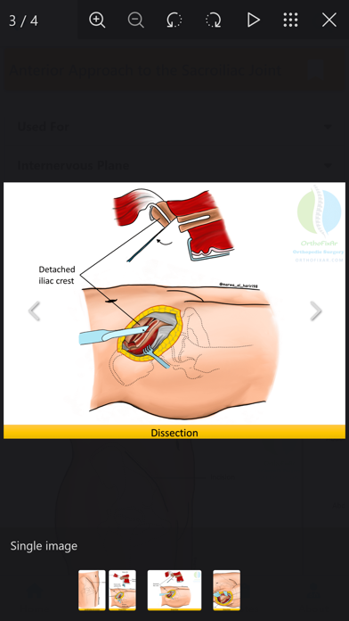 Orthopedic Surgery Approaches Screenshot