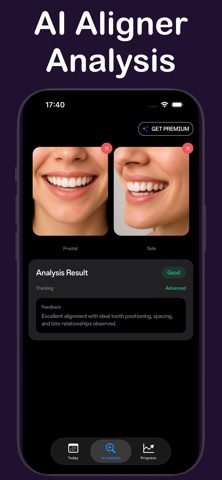 Aligner Progress Tracker iPhone screenshot