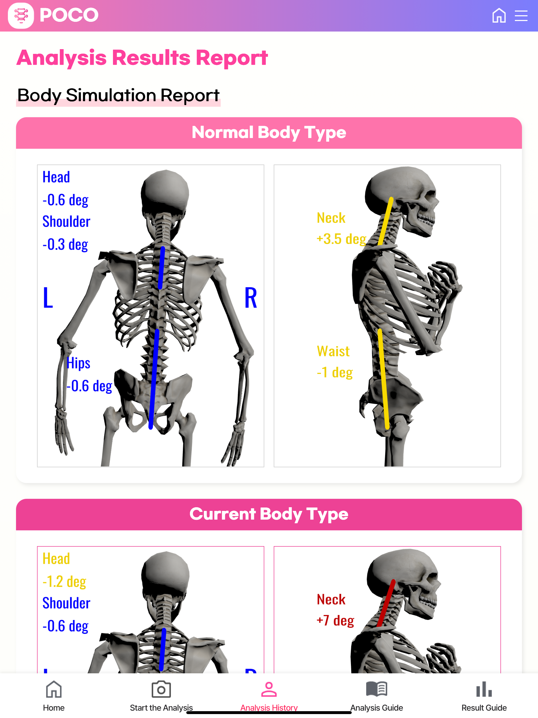 AI Posture Analysis
