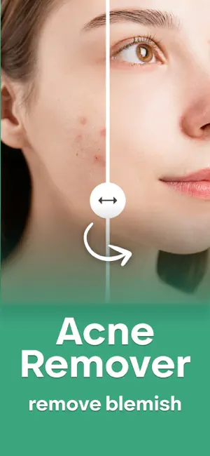 Acne Remover - Pimple Eraser screenshot 1