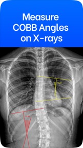 Cobb Angle Pro Spine X-Ray screenshot