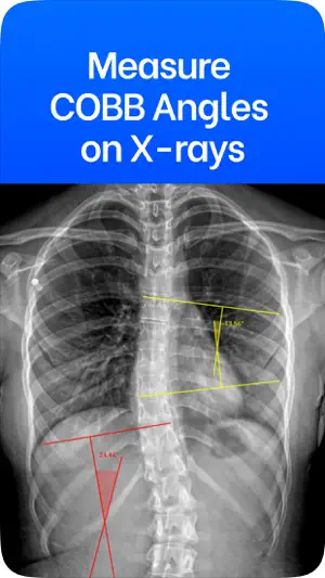 Cobb Angle Pro Spine X-Ray screenshot 1