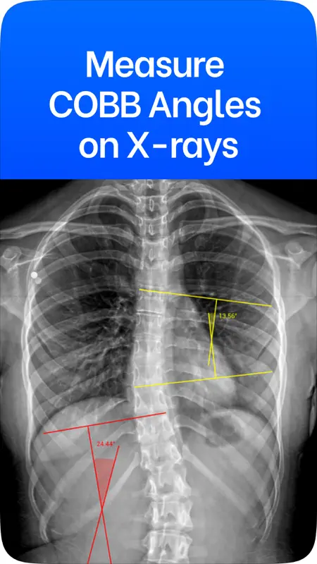 Cobb Angle Pro Radiografía screenshot 1 of 6